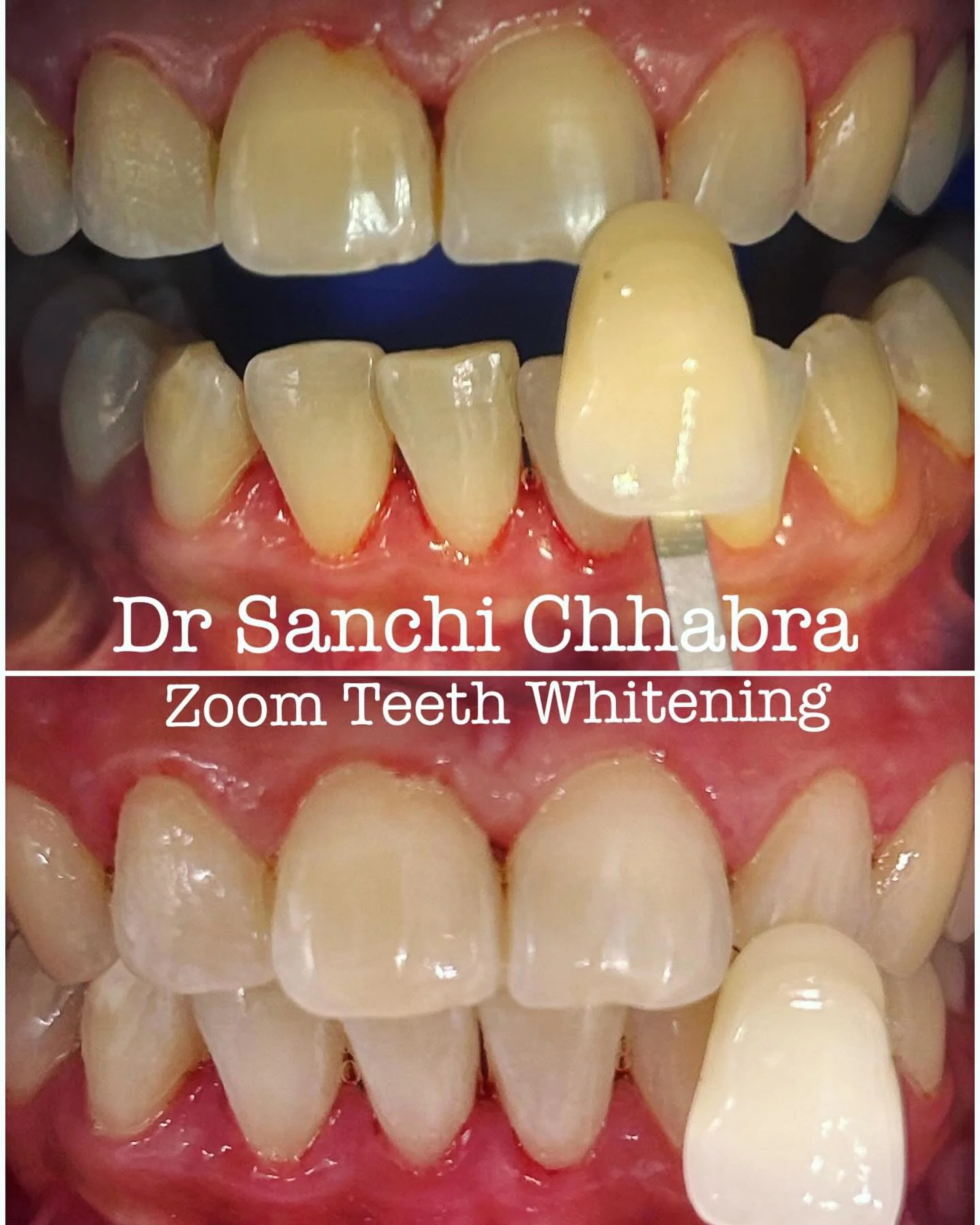 Smile Transformation 1