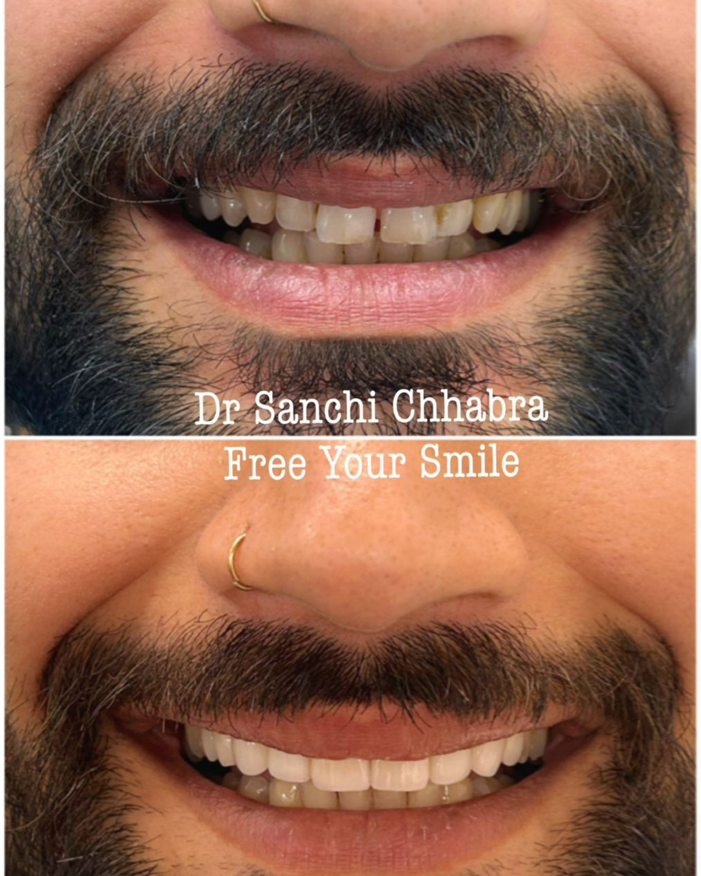 Smile Transformation 11