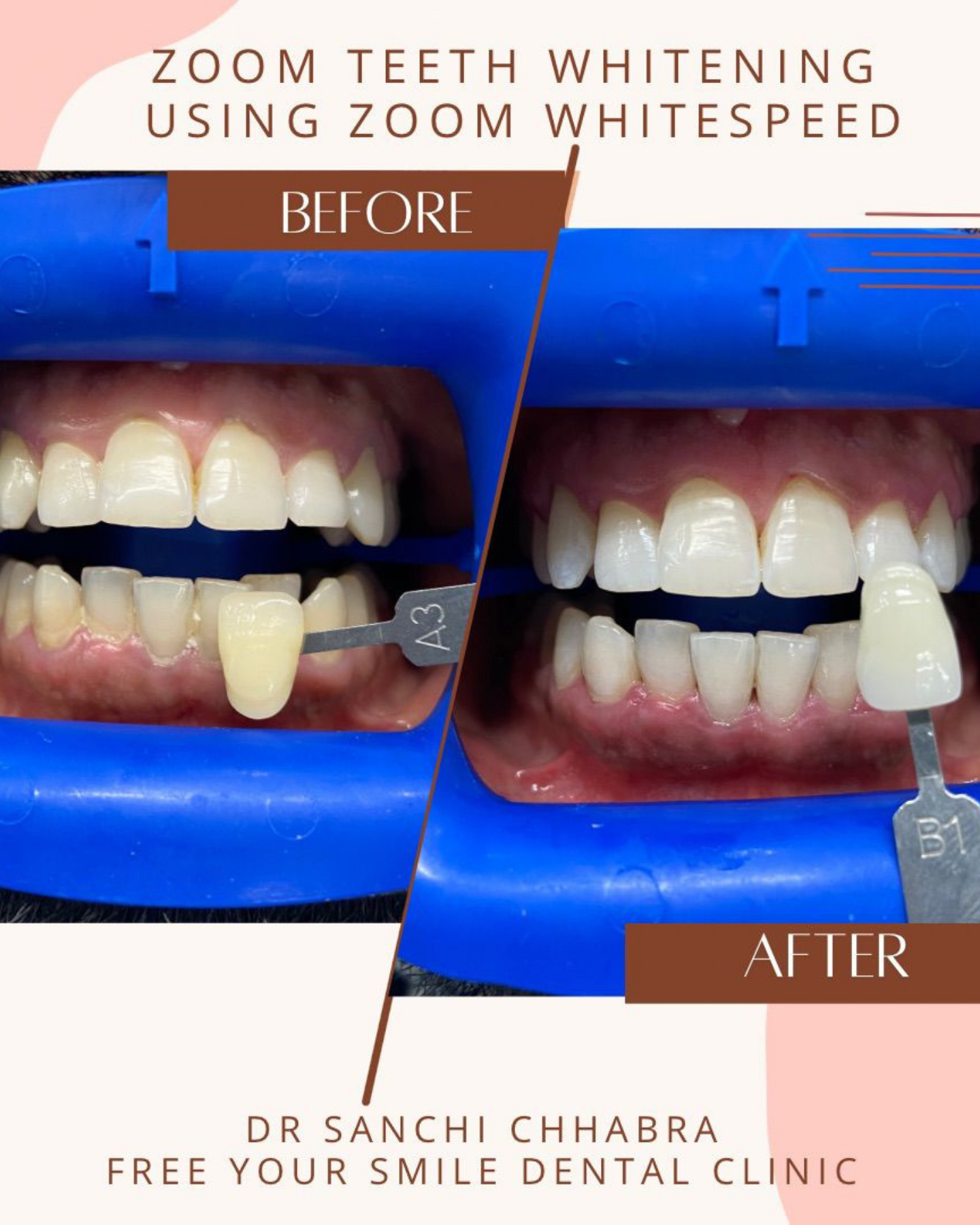 Smile Transformation 12
