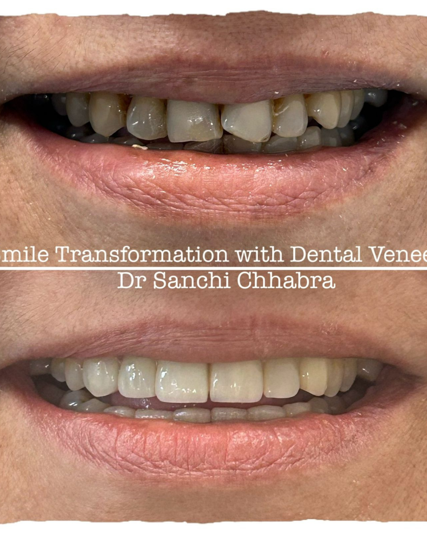 Smile Transformation 14