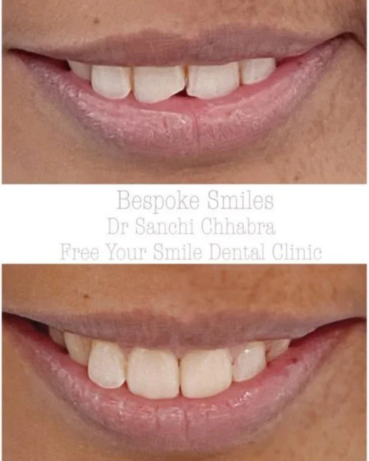 Smile Transformation 2