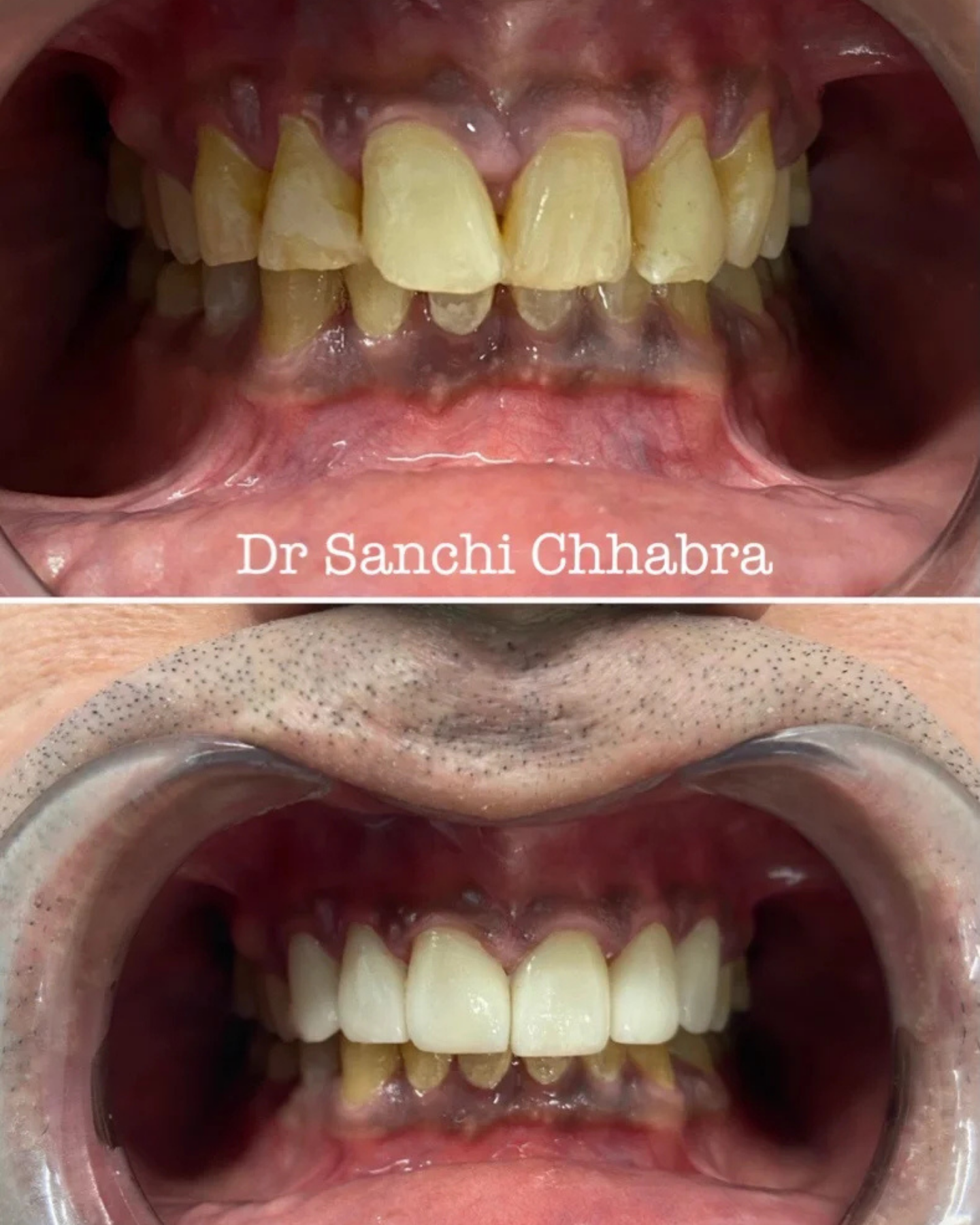 Smile Transformation 3