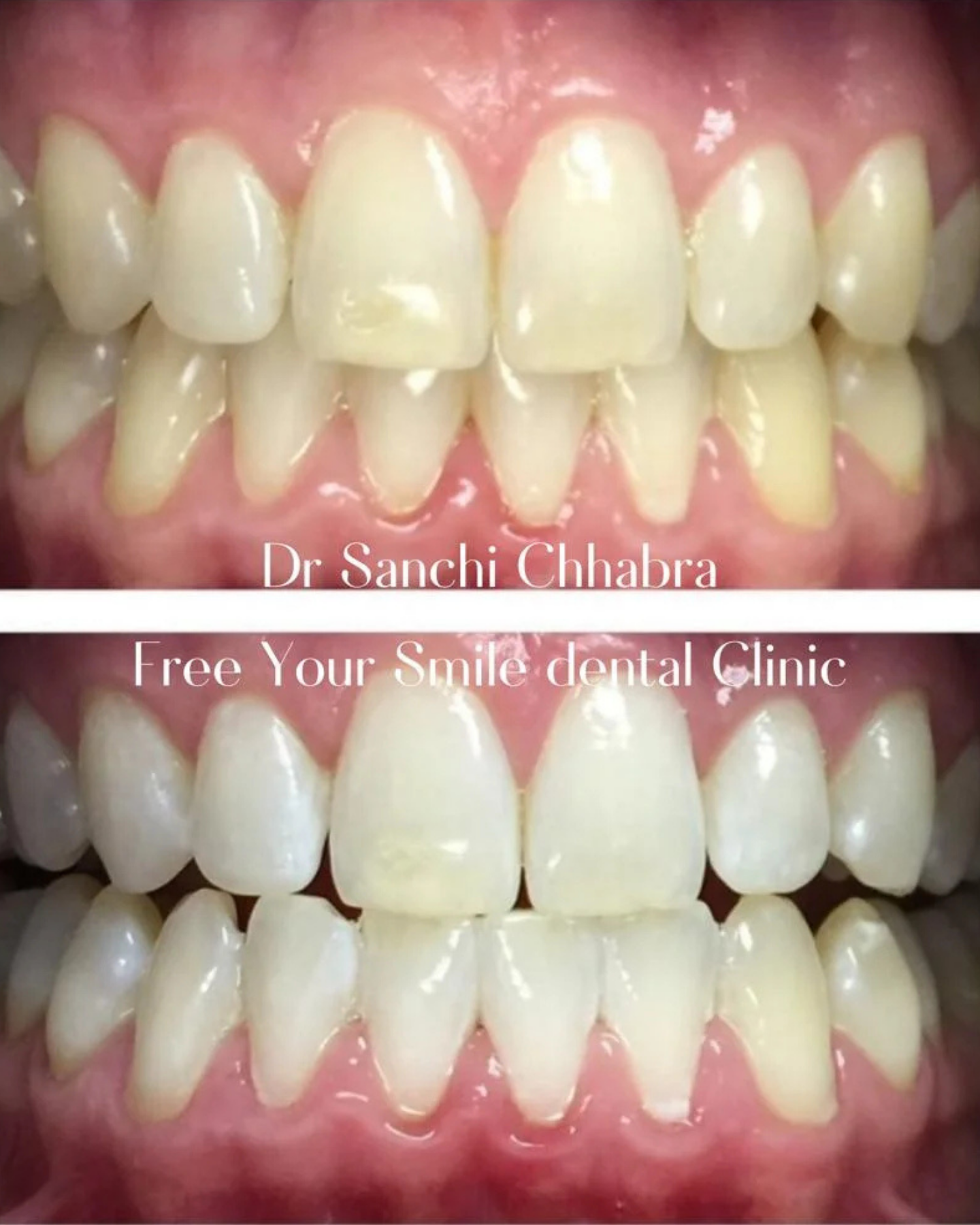 Smile Transformation 4