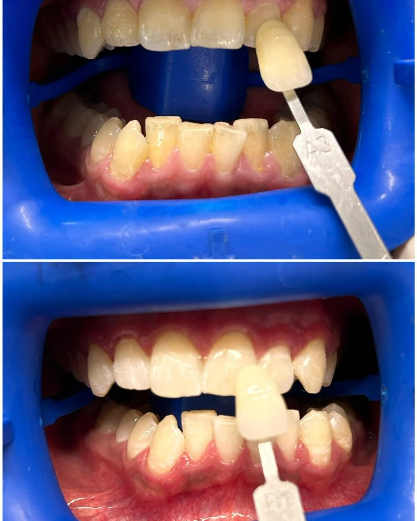 Smile Transformation 5