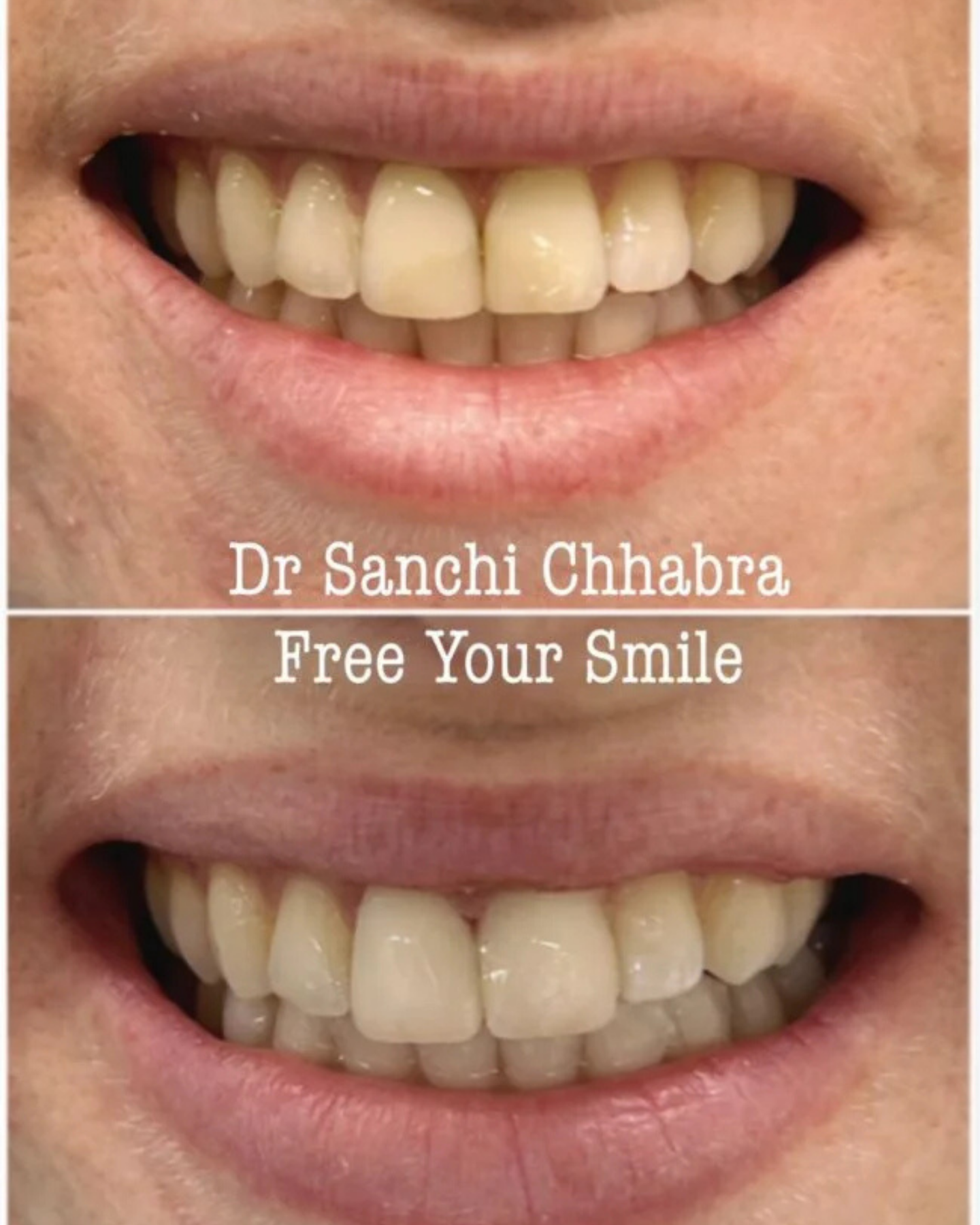 Smile Transformation 7