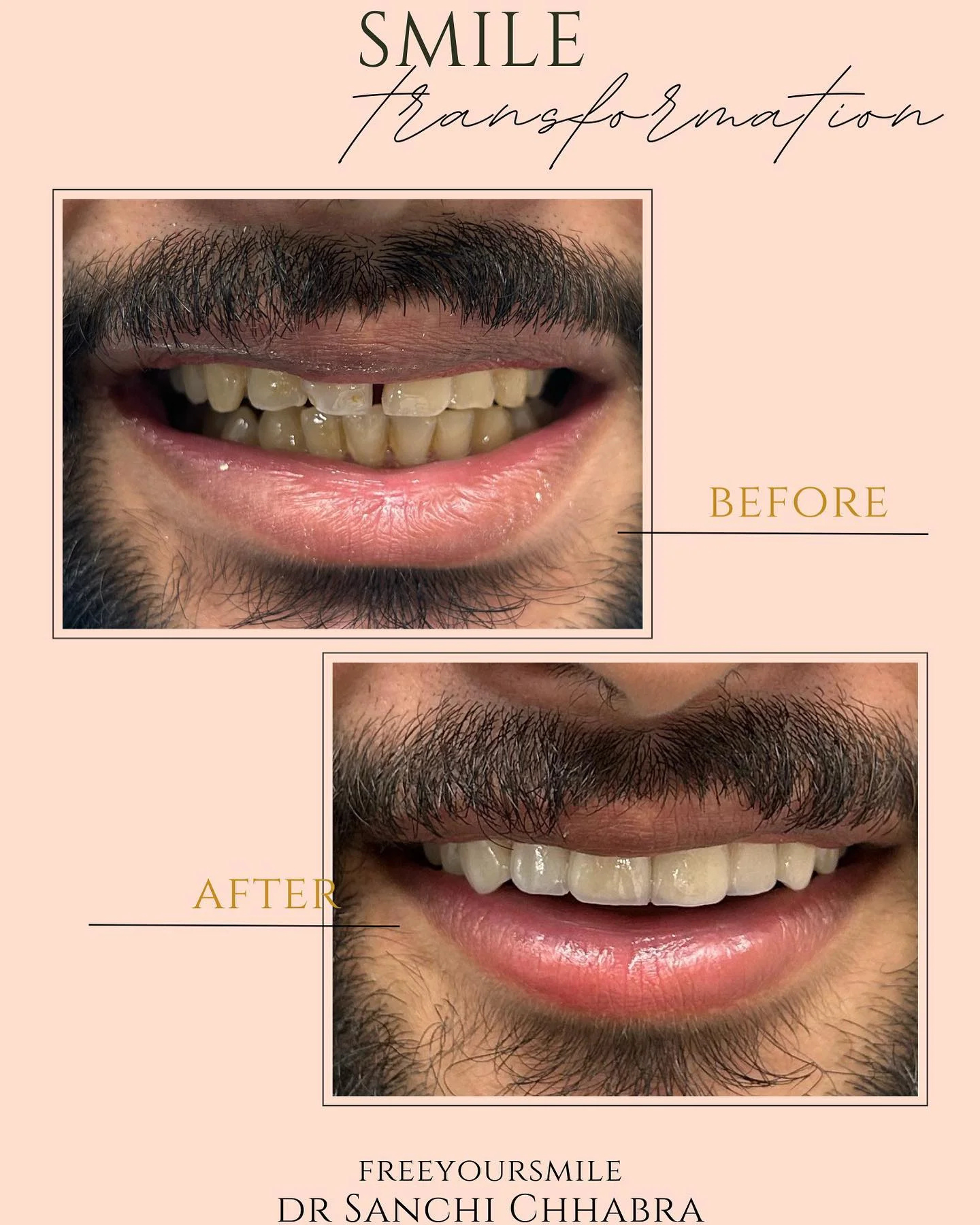 Smile Transformation 8